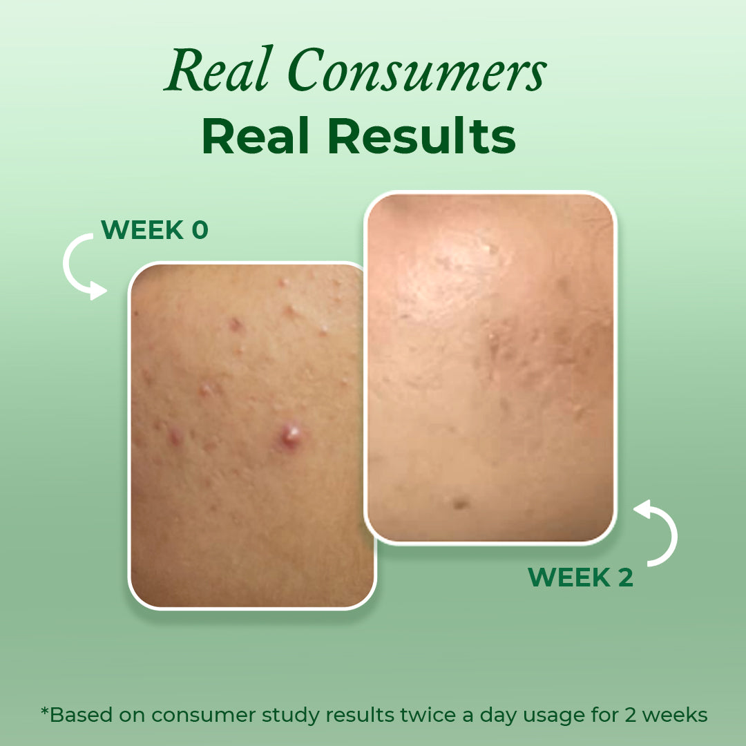 Consumer results after using the acne face wash by The Pink Foundry