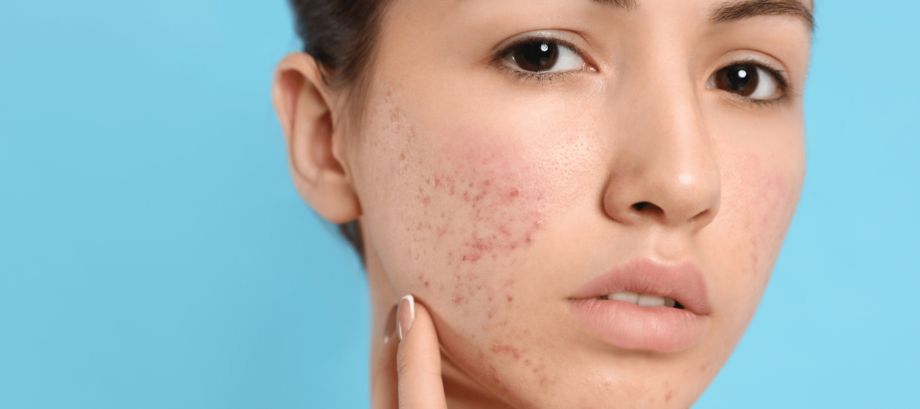 2023 Acne Face Mapping Guide