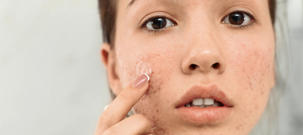 Look for signs that your acne is healing