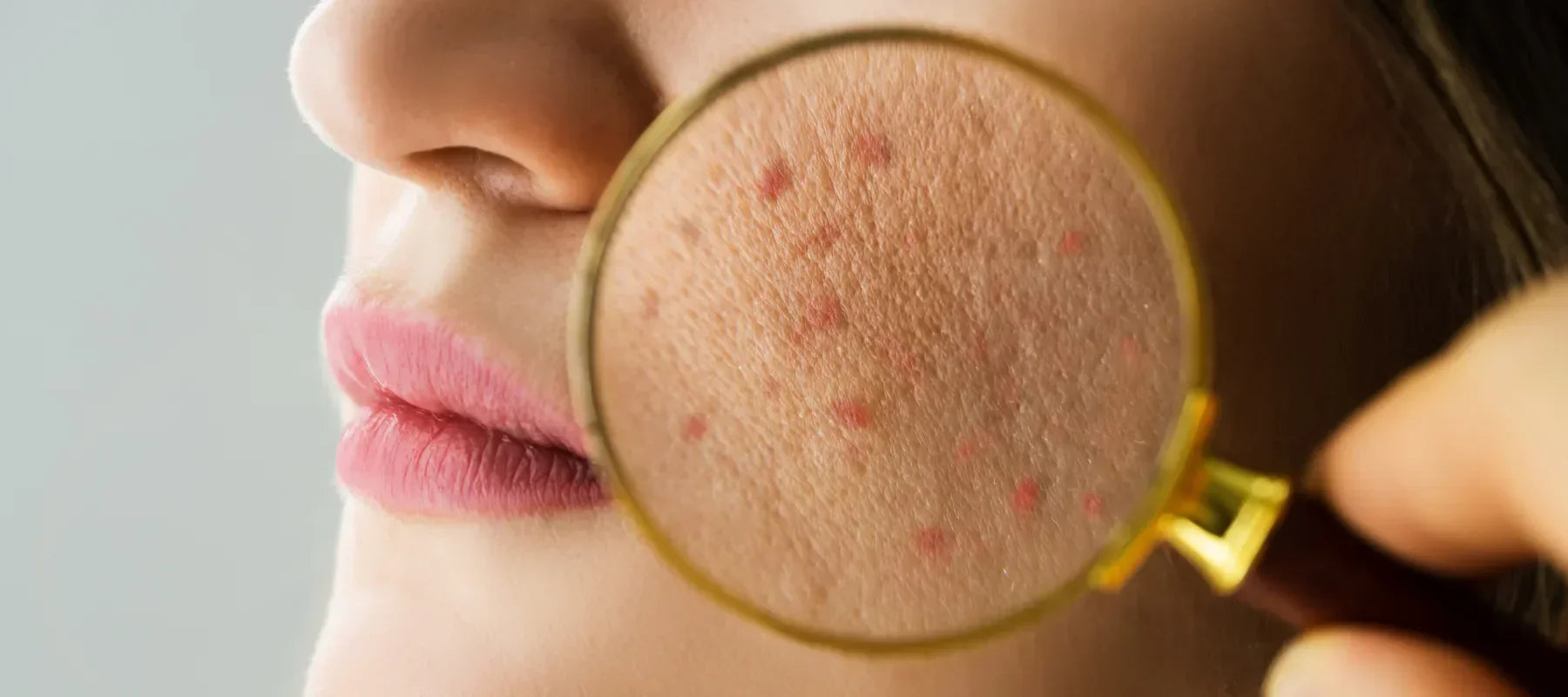 7 Types of Acne