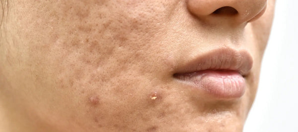Acne face map for understanding pimples