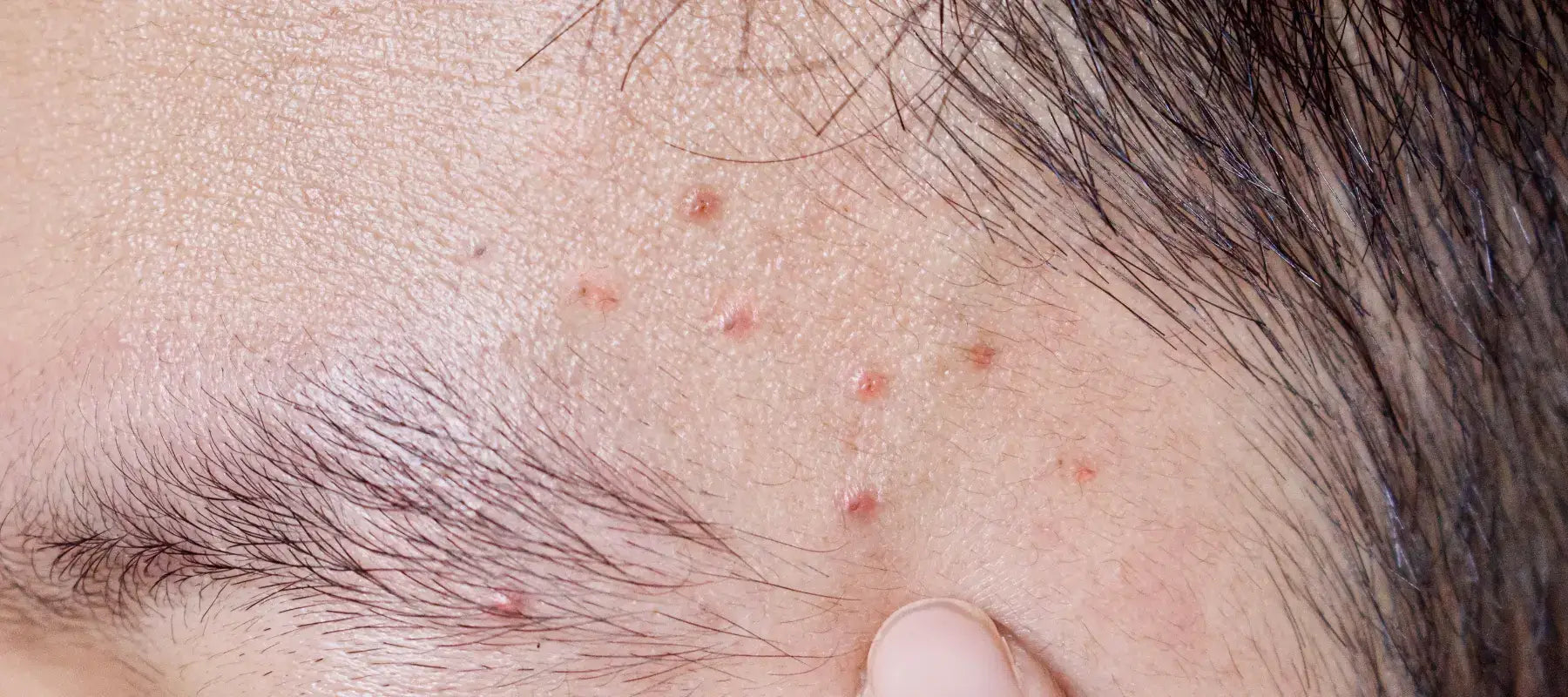 Acne mechanica cheek and forehead