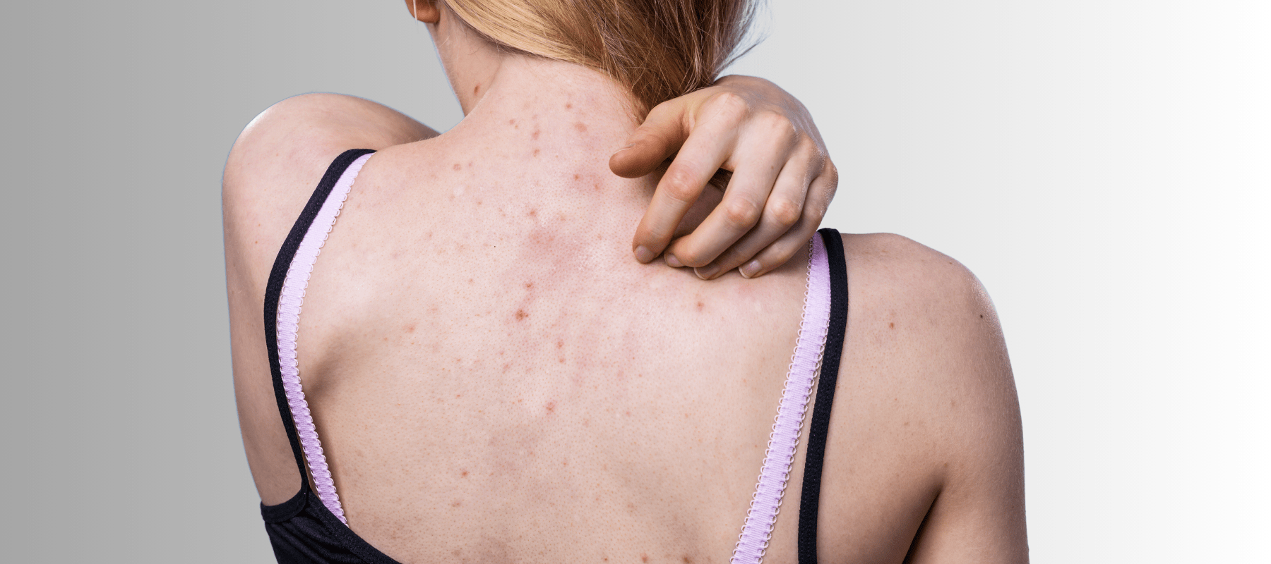 Acne on Back Reasons