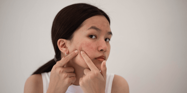 Adult Acne: Causes, Treatment and More