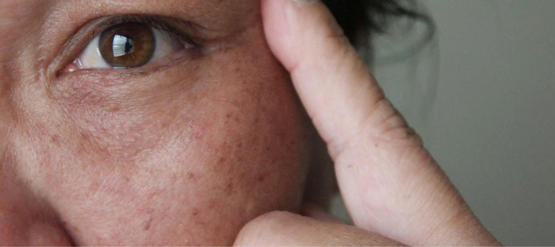 Black discoloration of skin: Meaning, causes and treatment |The Pink ...