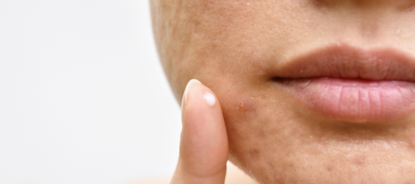 Can bacteria causes acne on your face?