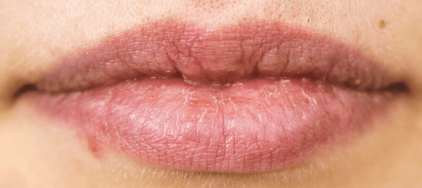 Causes and effective ways to get rid of lip pimples