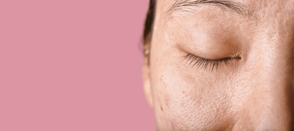 Causes and treatment of age spots on face