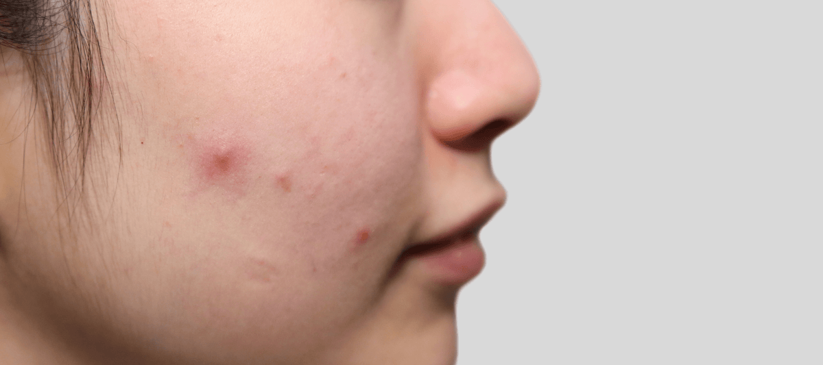 Comedonal Core Causes of Comedonal Acne for Clearer Skin | The Pink Foundry