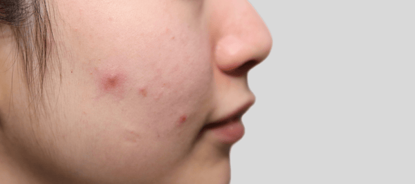causes of comedonal acne, highlighting insights for achieving clearer skin