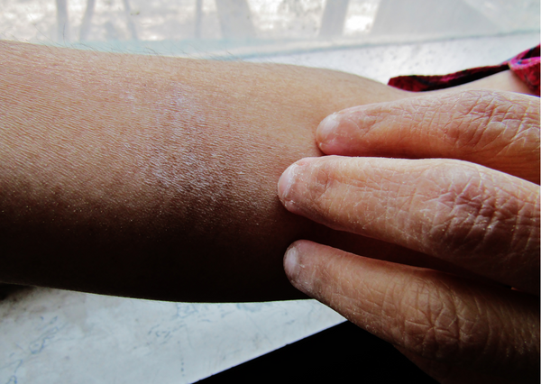 Causes of dry skin in winter and how to prevent it naturally?