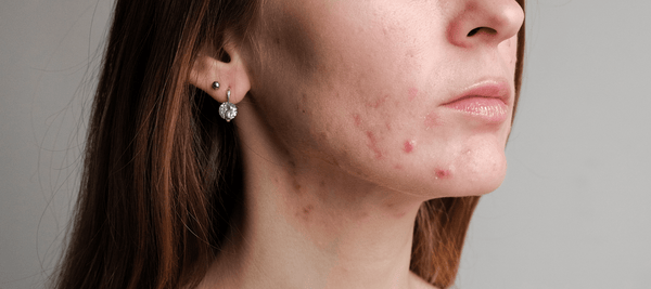 Causes, symptoms, and treatment options for papular acne
