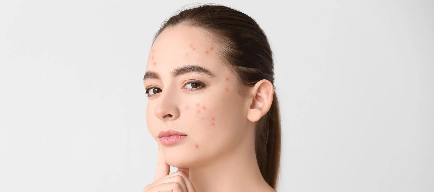Skin problems during pregnancy