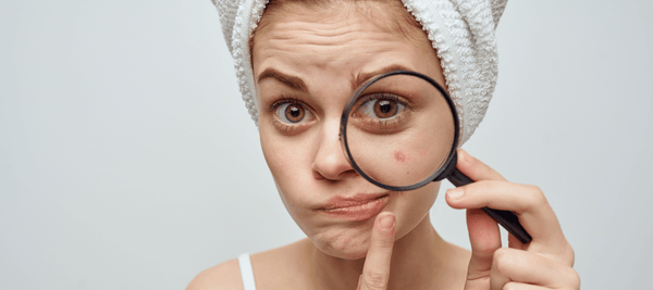 Comparison of Salicylic Acid and Benzoyl Peroxide for Acne Treatment