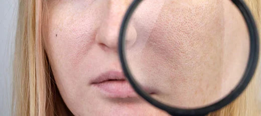 Open pores skin