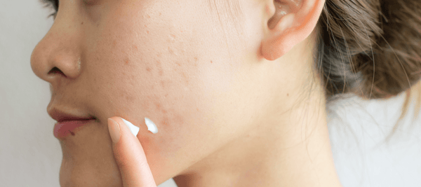 Complete detail for moisturiser can causes acne?