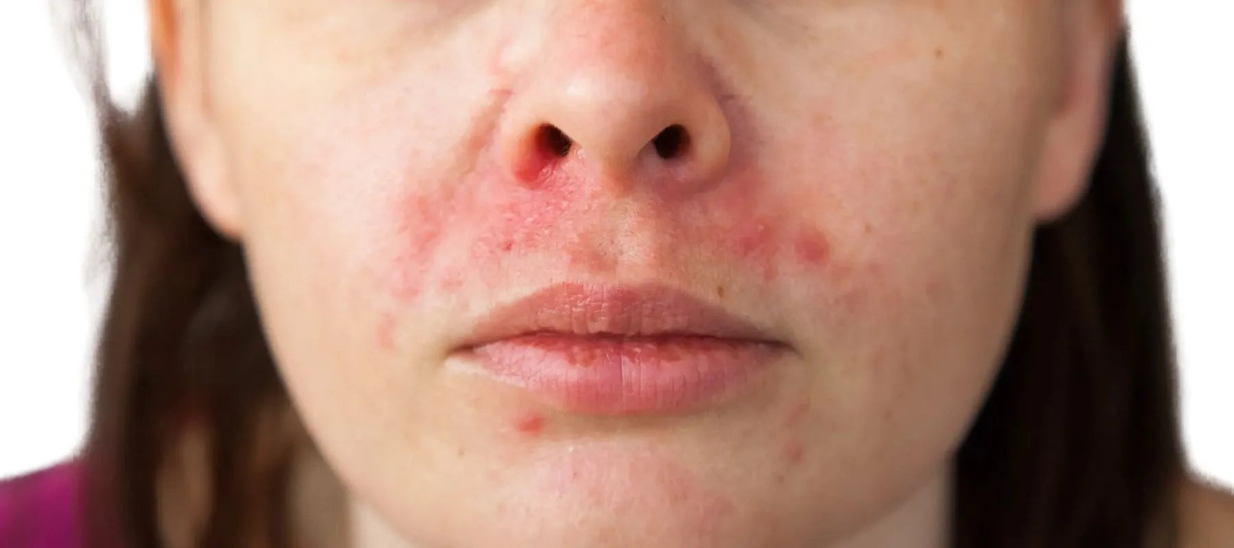 contact dermatitis on face