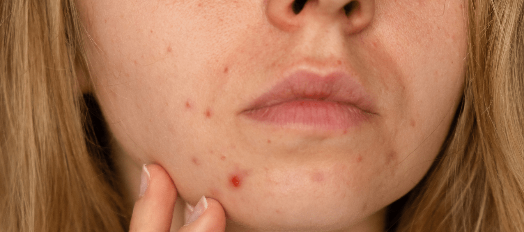 علل جای جوش