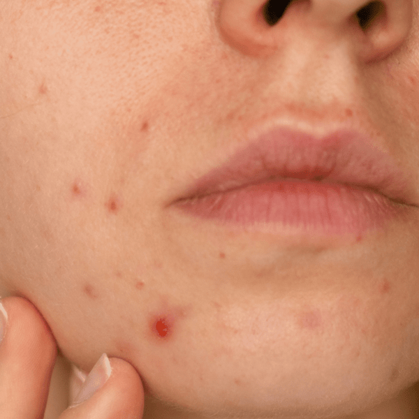 Boils on online face