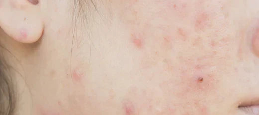 Does niacinamide cause purging?