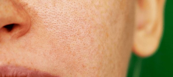 Following the guide to preventing open pores on the face