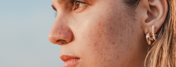 Hormonal Acne: Causes and Symptoms of hormonal acne
