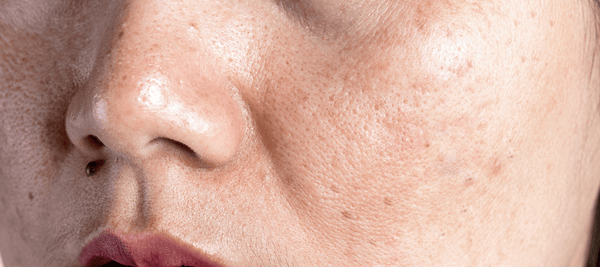 Highlighting the skin discoloration causes and treatments