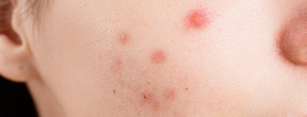 How to Treat Hormonal Acne and Get Rid of It
