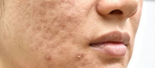 How to fill acne holes on face