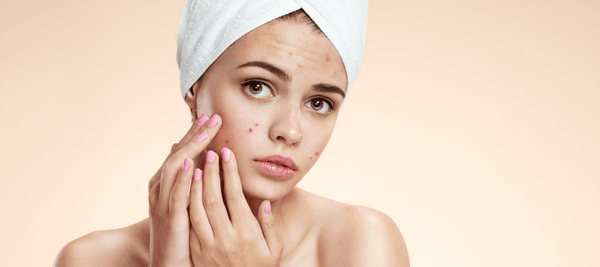 How to Cure Pus Pimples