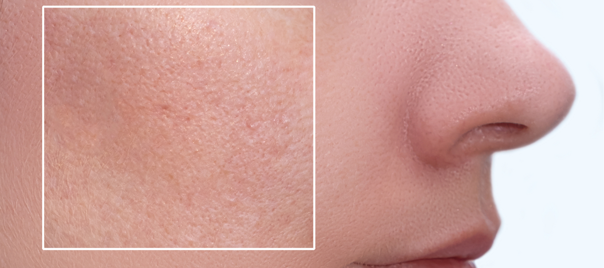Effective Tips to Reduce Pimples On Your Face Quickly | The Pink Foundry