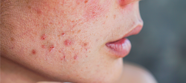 How to reduce the acne Redness?
