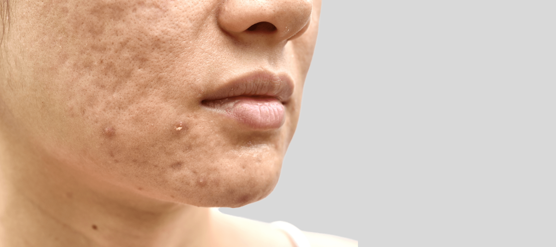 How to Remove Acne Marks