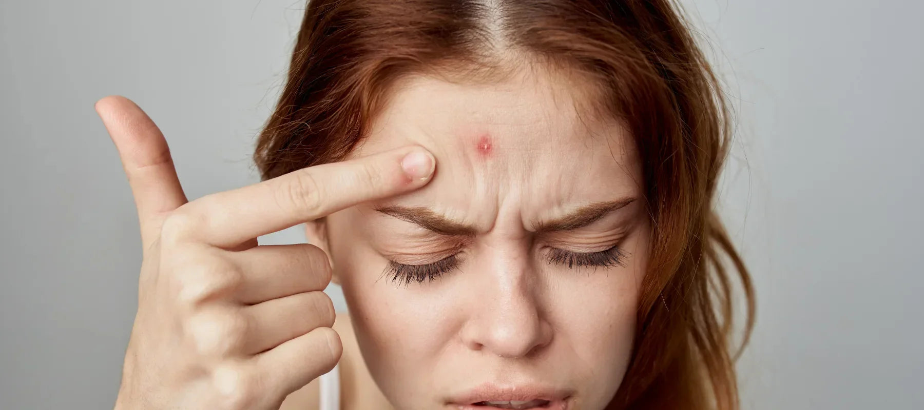 Shrink a Cystic Pimple Overnight