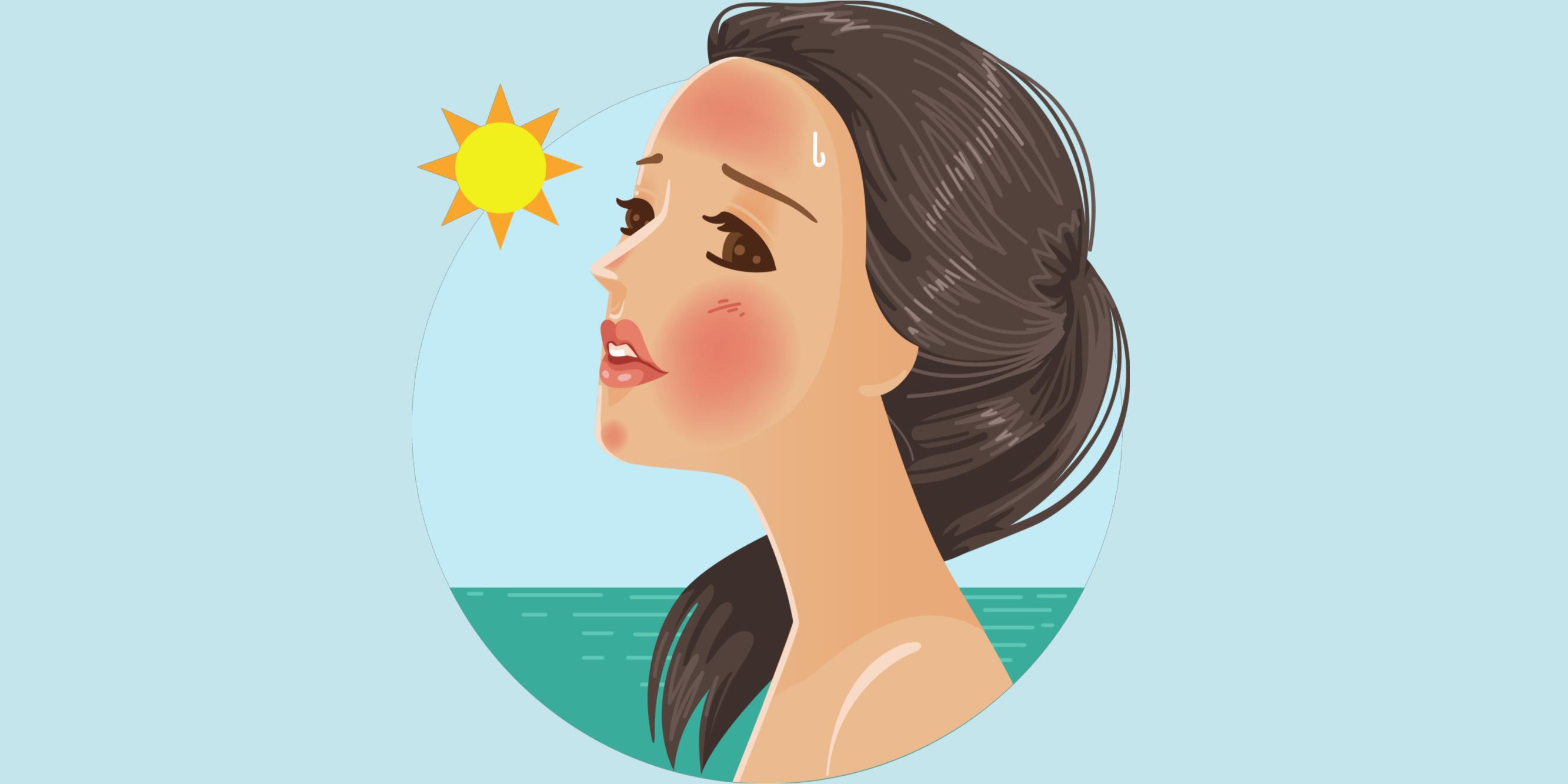 How to Treat Sunburn?