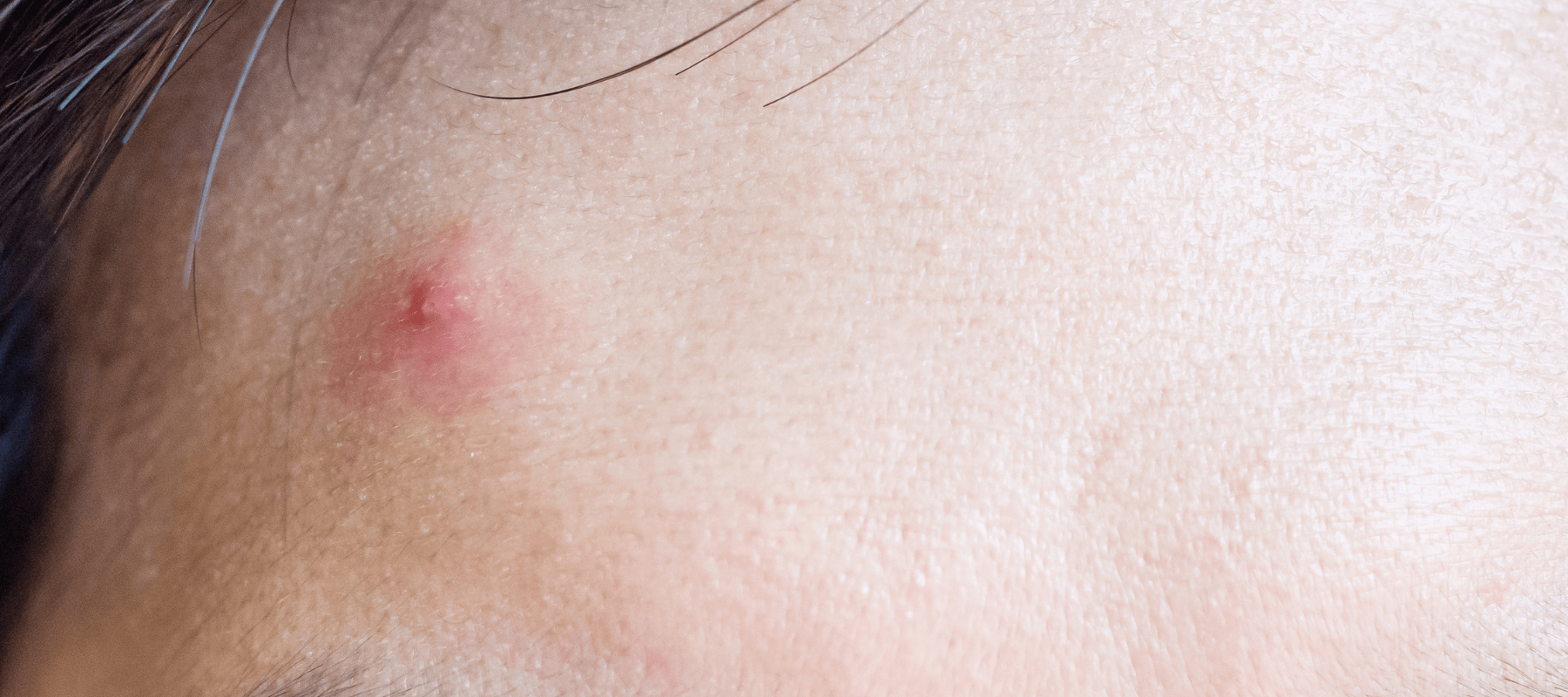 Understanding Inflammatory Acne: Causes, Symptoms, and Treatment Options