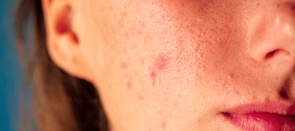 How to get rid of Cheek Acne