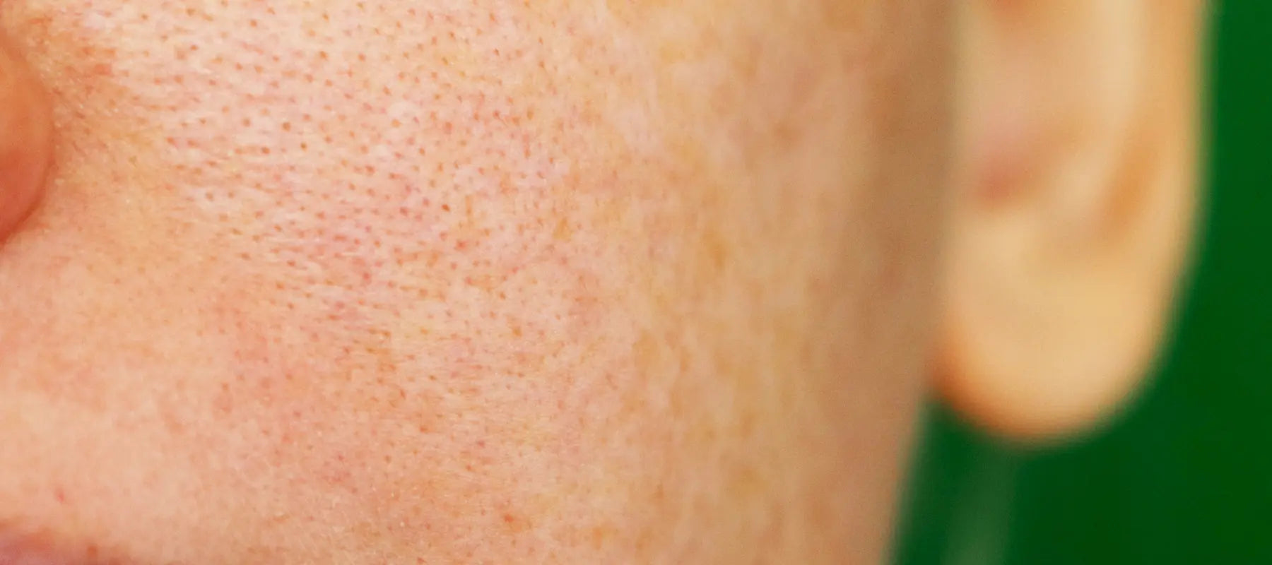 How to get rid of open pores on face