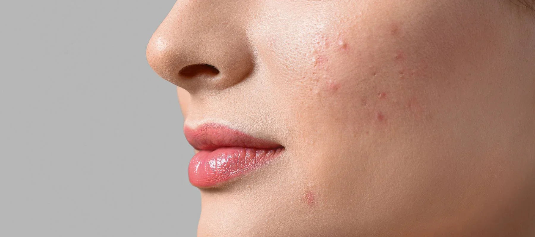 How to handle pimples under the skin | The Pink Foundry