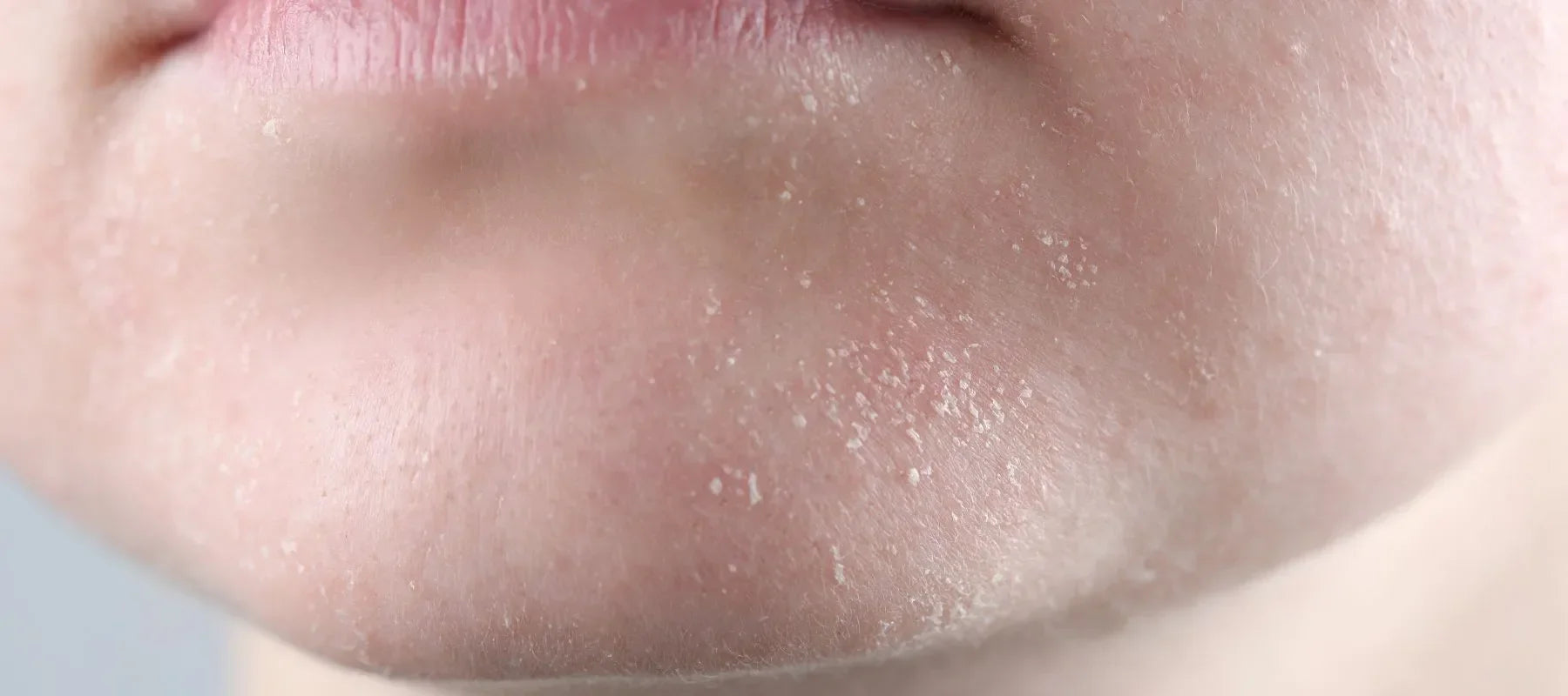 Skin peeling on face