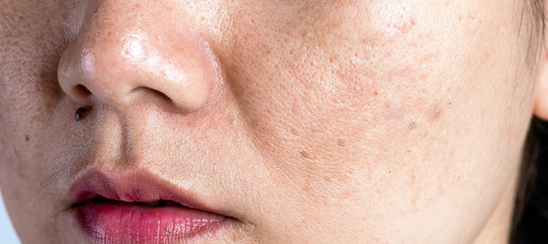 Flaky skin on face causes and treatments
