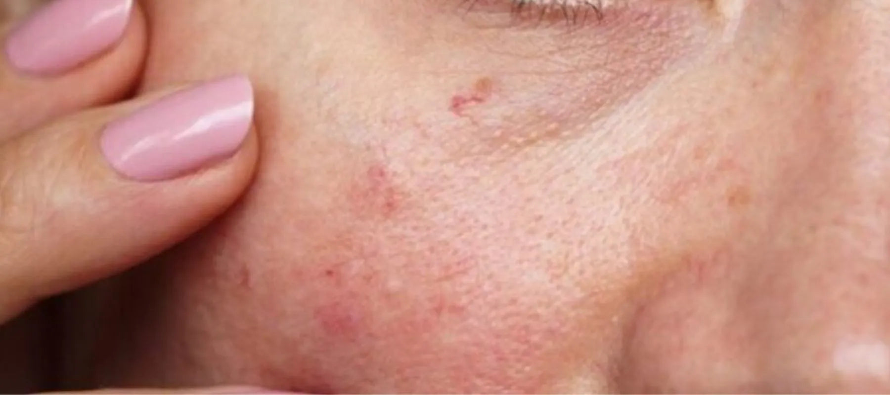 Capillaries on face