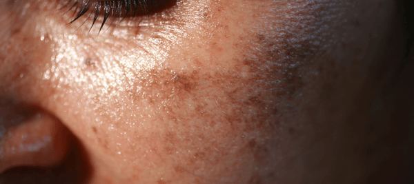 How to prevent pigmentation on face