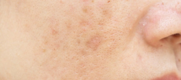 How to remove dark spots caused by pimples