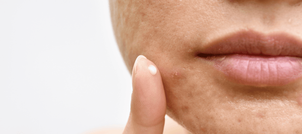how to remove pimple marks and treatment for it