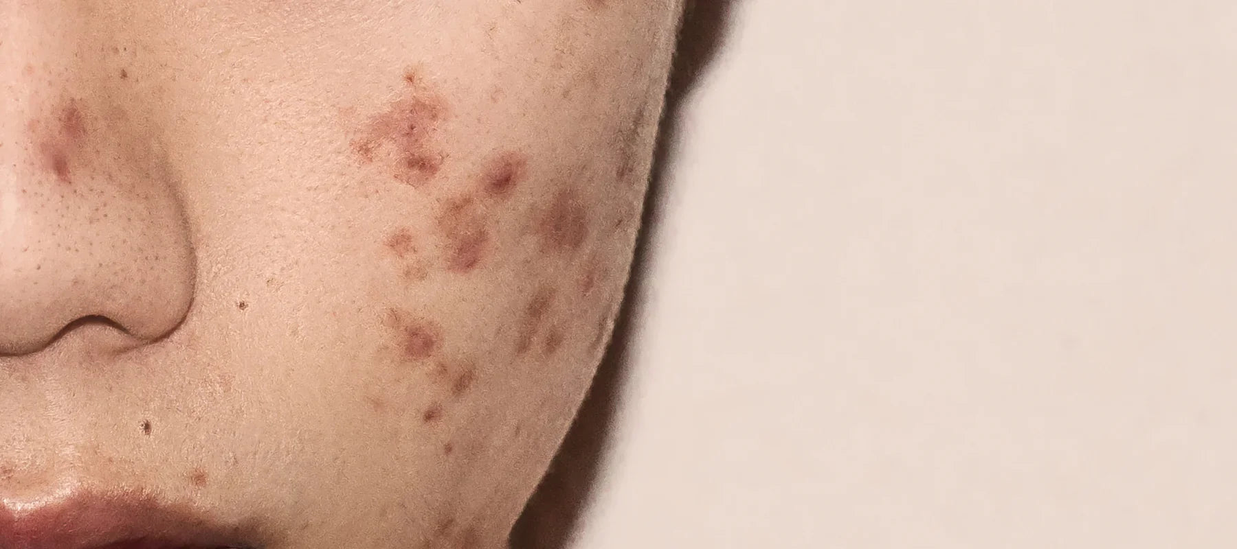 Niacinamide for pigmentation