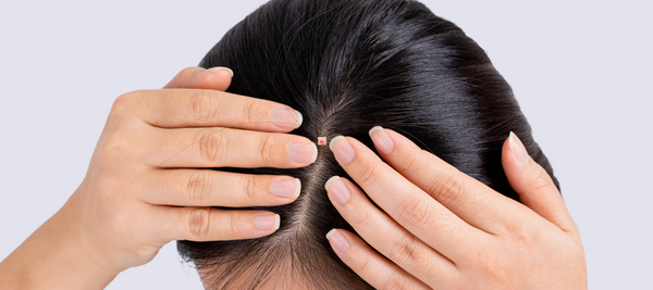 The Surprising Causes of Pimples on Your Head