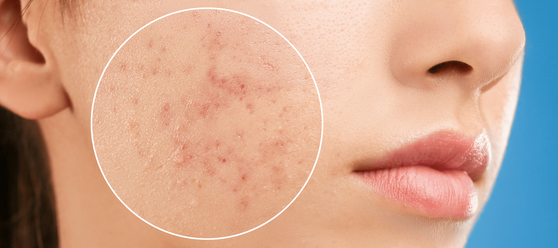 How to Prevent Pimples from Appearing on Your Face | The Pink Foundry