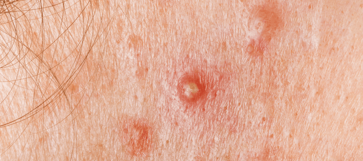 Acne Nodular Pop Should You Pop Pimples? A Dermatologist Weighs In