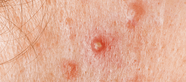 Know the causes and symptoms of nodular acne